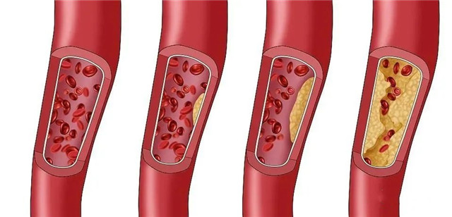 幹細胞幫助改善高(gāo)血脂，有(yǒu)效防止并發症