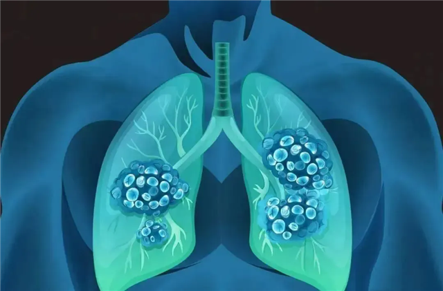 外(wài)泌體(tǐ)霧化(huà)療法：安全、高(gāo)效的(de)肺部損傷治療新選擇